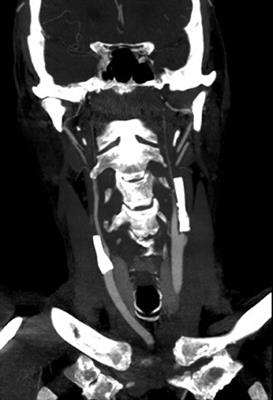 Case report: Combined acute revascularization in early bilateral carotid stent occlusion